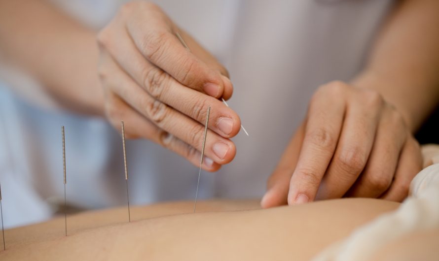Acupunctura și beneficiile sale în tratarea durerii